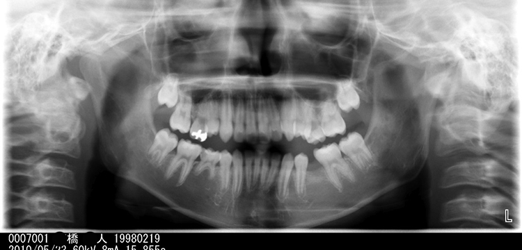 「ハリウッドスマイル13症例めの矯正歯科治療前のレントゲン」
